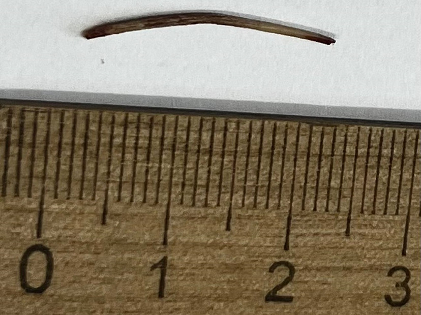 Саратовец два года мучился от острой боли в животе и лихорадки: в его кишечнике нашли рыбью кость Саратовец два года мучился от острой боли в животе и лихорадки: в его кишечнике нашли рыбью кость